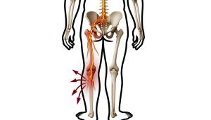 Cómo aliviar el dolor de ciática